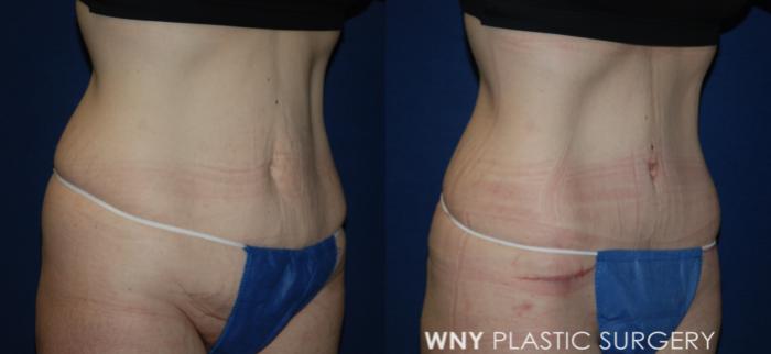 Before & After Tummy Tuck Case 188 Right Oblique View in Williamsville, NY