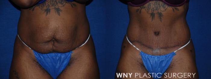 Before & After Tummy Tuck Case 198 Front View in Williamsville, NY