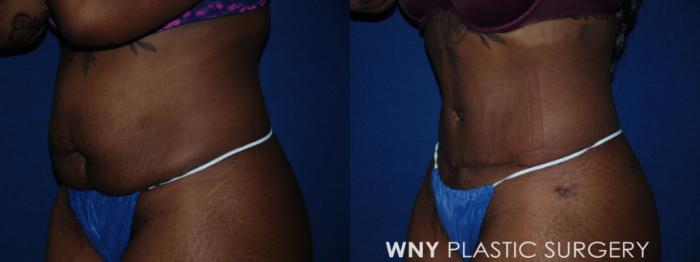 Before & After Tummy Tuck Case 198 Left Oblique View in Buffalo, NY