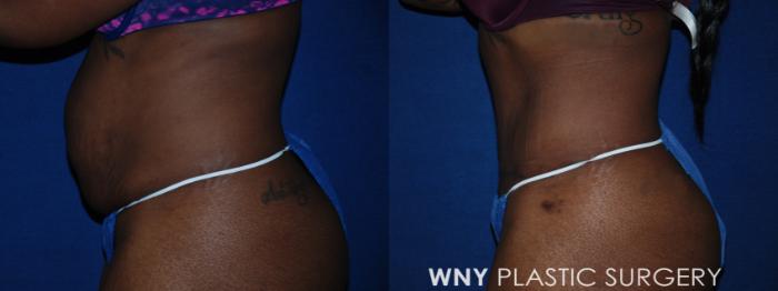 Before & After Tummy Tuck Case 198 Left Side View in Buffalo, NY
