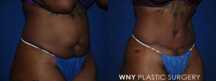 Before & After Tummy Tuck Case 198 Right Oblique View in Buffalo, NY