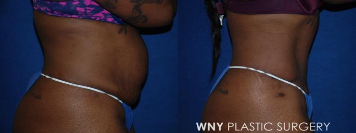 Before & After Tummy Tuck Case 198 Right Side View in Buffalo, NY
