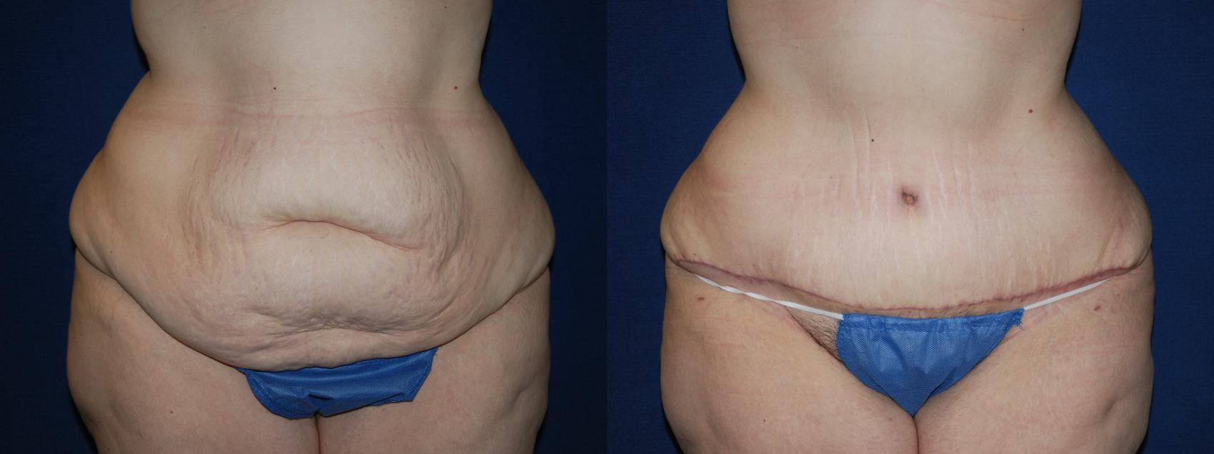 Before & After Tummy Tuck Case 205 Front View in Buffalo, NY