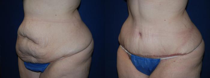 Before & After Tummy Tuck Case 205 Left Oblique View in Buffalo, NY