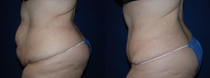 Before & After Tummy Tuck Case 205 Left Side View in Buffalo, NY