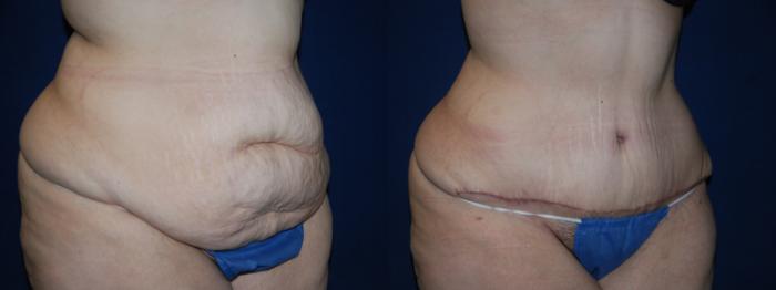 Before & After Tummy Tuck Case 205 Right Oblique View in Buffalo, NY