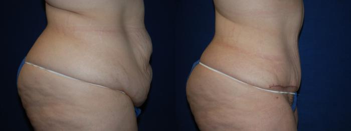 Before & After Tummy Tuck Case 205 Right Side View in Buffalo, NY
