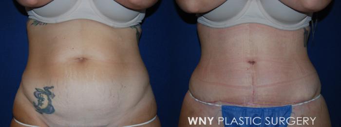 Before & After Tummy Tuck Case 227 Front View in Buffalo, NY