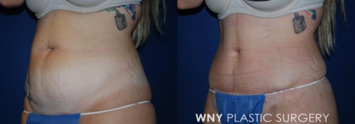 Before & After Tummy Tuck Case 227 Left Oblique View in Buffalo, NY