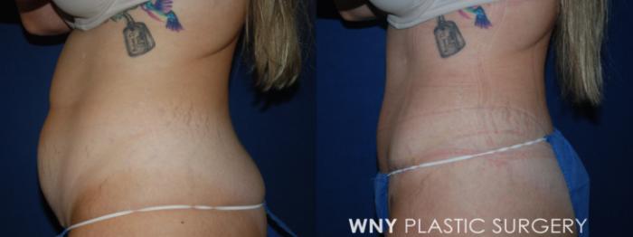 Before & After Tummy Tuck Case 227 Left Side View in Buffalo, NY