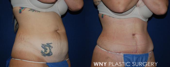 Before & After Tummy Tuck Case 227 Right Oblique View in Buffalo, NY