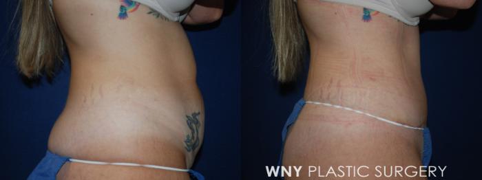 Before & After Tummy Tuck Case 227 Right Side View in Buffalo, NY