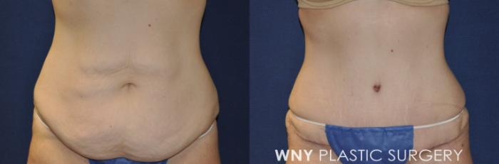 Before & After Tummy Tuck Case 232 Front View in Buffalo, NY