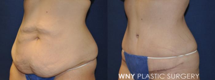 Before & After Tummy Tuck Case 232 Left Oblique View in Buffalo, NY