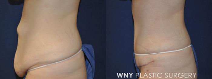 Before & After Tummy Tuck Case 232 Left Side View in Buffalo, NY