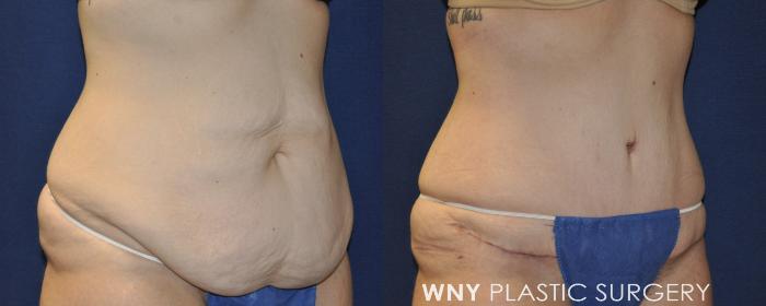 Before & After Tummy Tuck Case 232 Right Oblique View in Buffalo, NY