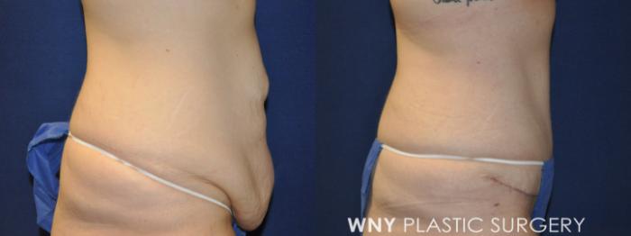 Before & After Tummy Tuck Case 232 Right Side View in Buffalo, NY