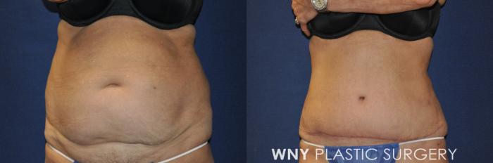 Before & After Liposuction Case 240 Front View in Buffalo, NY