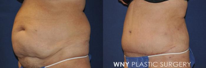 Before & After Tummy Tuck Case 240 Left Oblique View in Buffalo, NY
