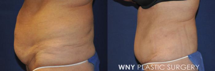 Before & After Tummy Tuck Case 240 Left Side View in Buffalo, NY