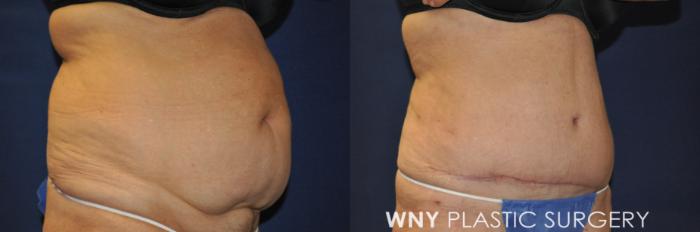 Before & After Tummy Tuck Case 240 Right Oblique View in Buffalo, NY
