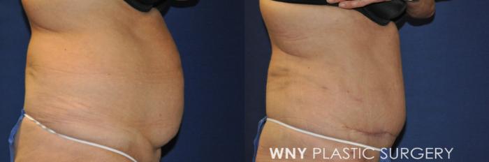 Before & After Tummy Tuck Case 240 Right Side View in Buffalo, NY