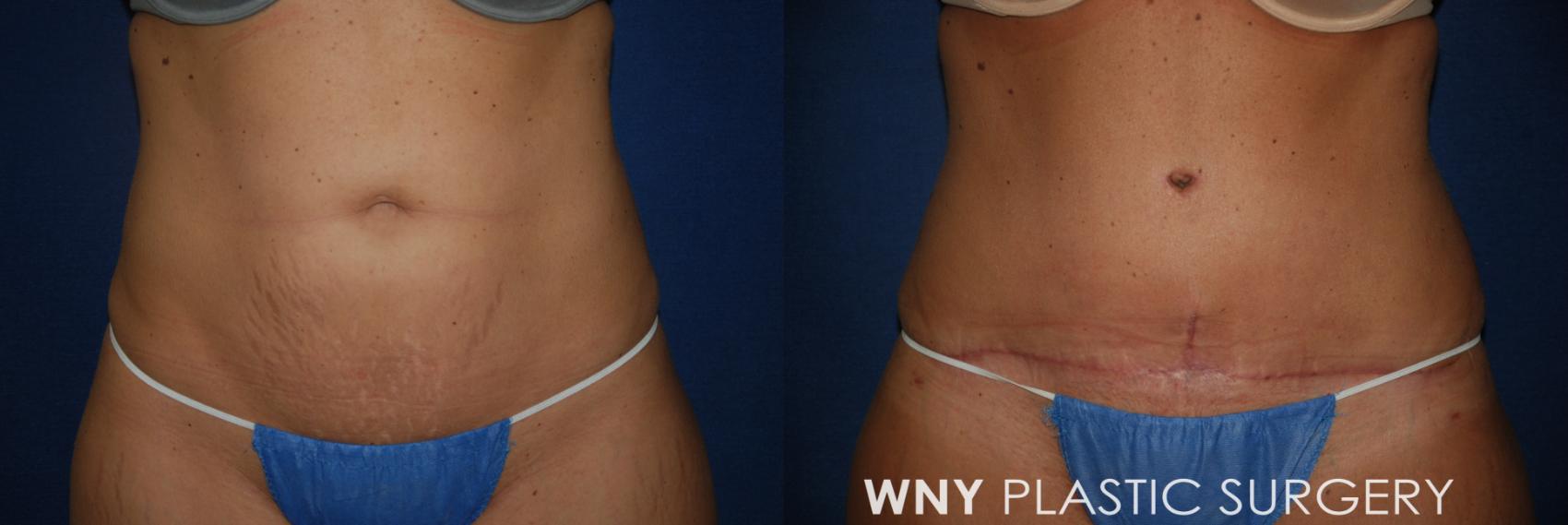 Before & After Tummy Tuck Case 26 Front View in Buffalo, NY