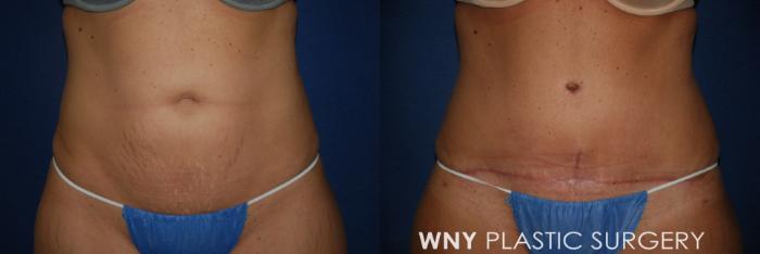 Before & After Tummy Tuck Case 26 Front View in Buffalo, NY