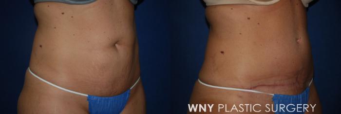Before & After Tummy Tuck Case 26 Right Oblique View in Buffalo, NY