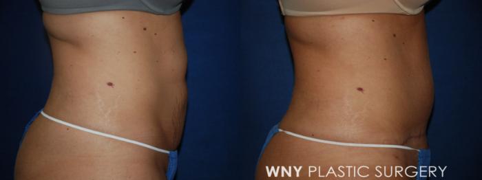 Before & After Tummy Tuck Case 26 Right Side View in Buffalo, NY