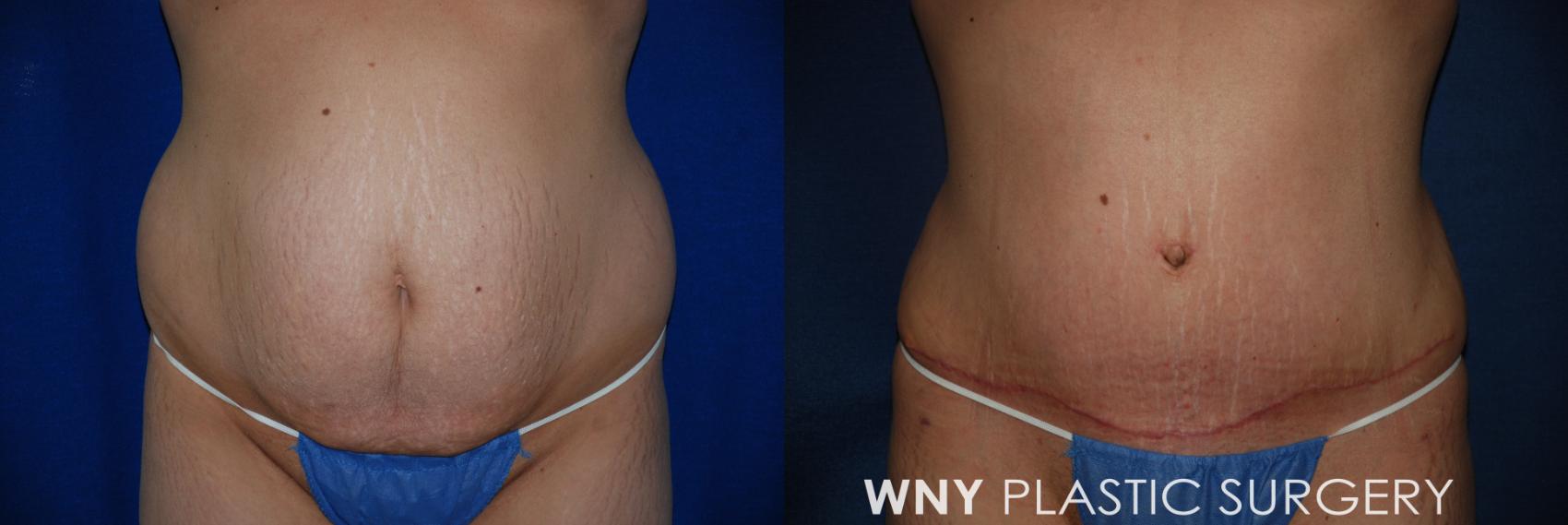 Before & After Tummy Tuck Case 27 View #1 View in Williamsville, NY