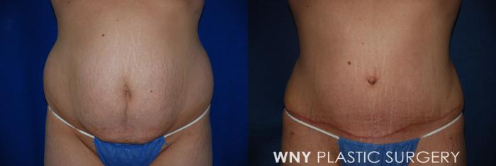 Before & After Tummy Tuck Case 27 View #1 View in Buffalo, NY