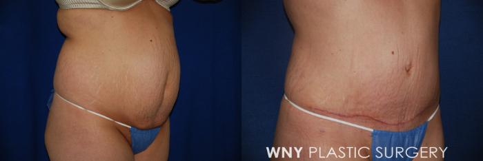 Before & After Tummy Tuck Case 27 View #2 View in Buffalo, NY
