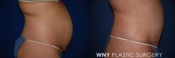 Before & After Tummy Tuck Case 27 View #3 View in Buffalo, NY