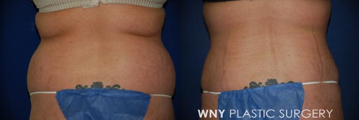 Before & After Tummy Tuck Case 27 View #4 View in Buffalo, NY