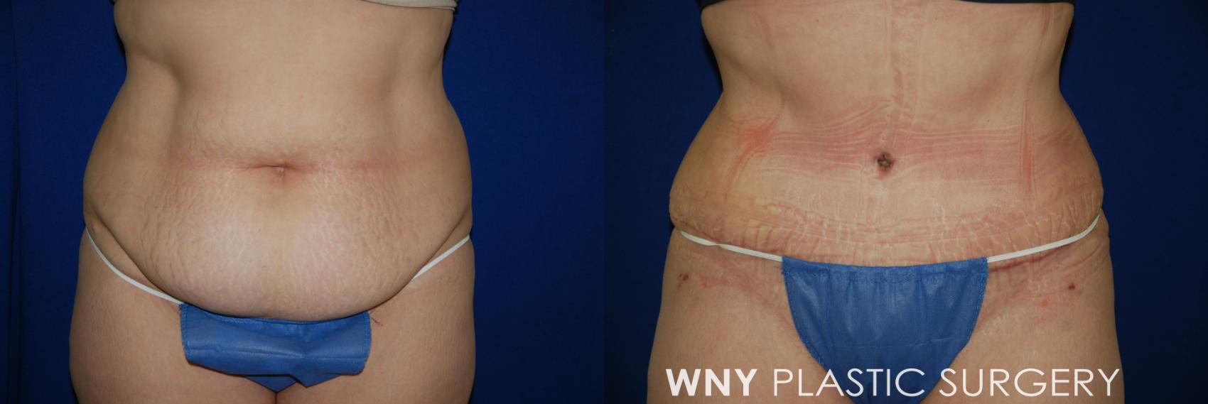 Before & After Tummy Tuck Case 29 View #1 View in Williamsville, NY