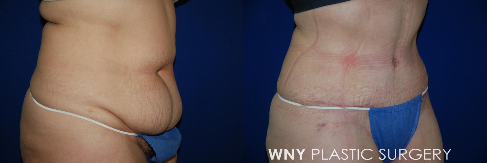 Before & After Tummy Tuck Case 29 View #2 View in Williamsville, NY