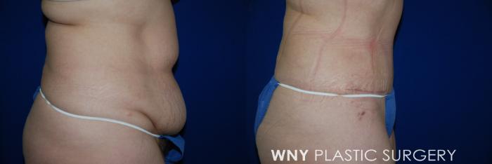 Before & After Tummy Tuck Case 29 View #3 View in Williamsville, NY