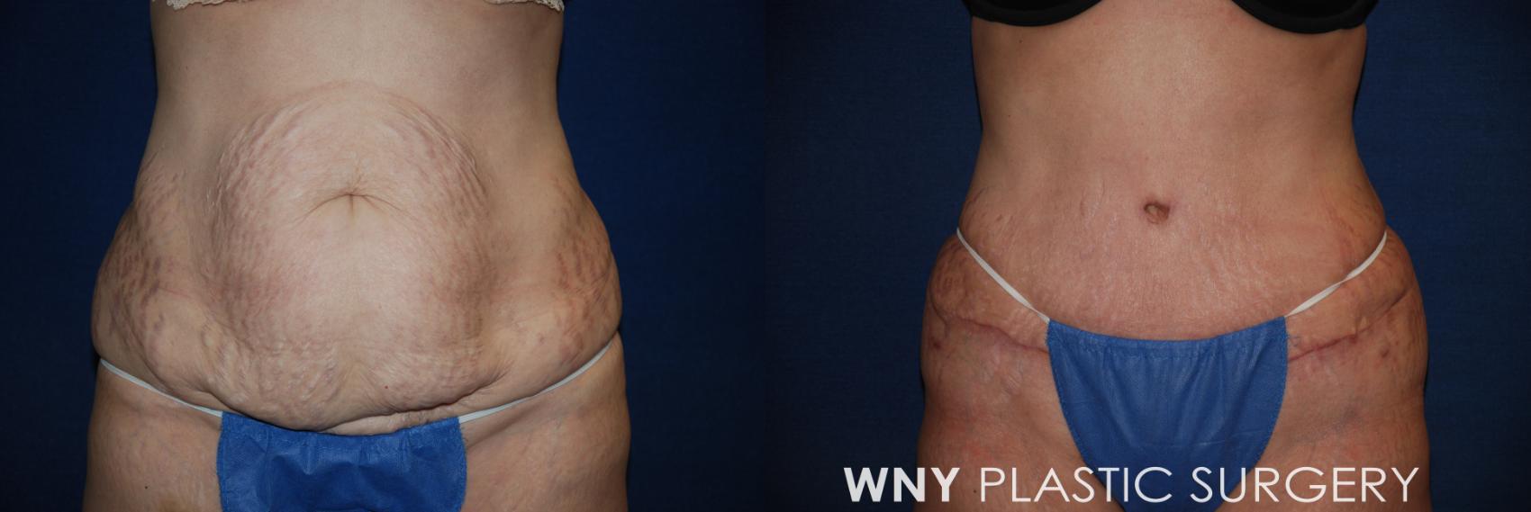 Before & After Tummy Tuck Case 30 View #1 View in Williamsville, NY