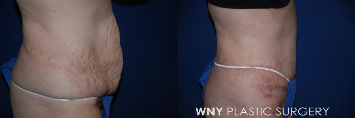 Before & After Tummy Tuck Case 30 View #2 View in Buffalo, NY