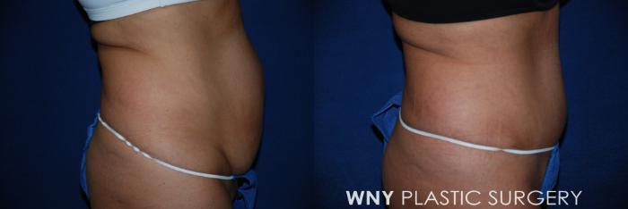 Before & After Tummy Tuck Case 32 View #2 View in Williamsville, NY