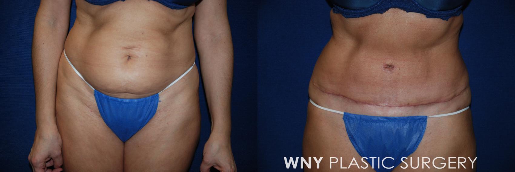 Before & After Tummy Tuck Case 33 View #1 View in Williamsville, NY