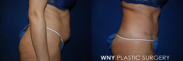 Before & After Tummy Tuck Case 33 View #2 View in Williamsville, NY