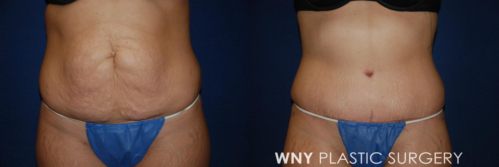 Before & After Tummy Tuck Case 34 View #1 View in Williamsville, NY