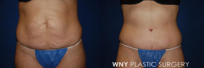 Before & After Tummy Tuck Case 34 View #1 View in Buffalo, NY