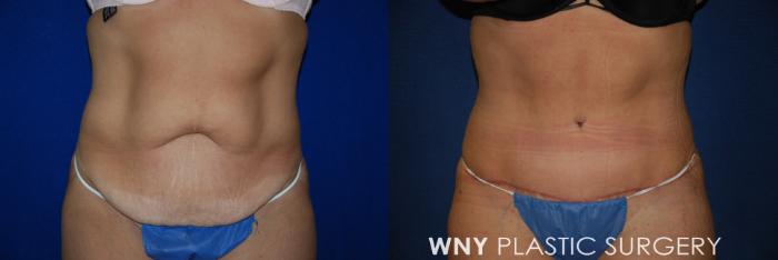 Before & After Tummy Tuck Case 96 View #1 View in Buffalo, NY