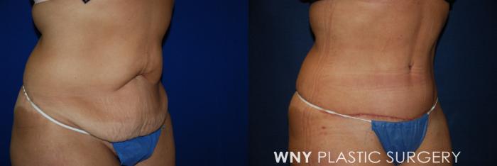 Before & After Tummy Tuck Case 96 View #2 View in Buffalo, NY