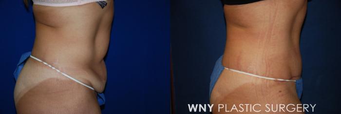 Before & After Tummy Tuck Case 96 View #3 View in Buffalo, NY